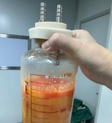 兰州水动力吸脂手术要做多久？